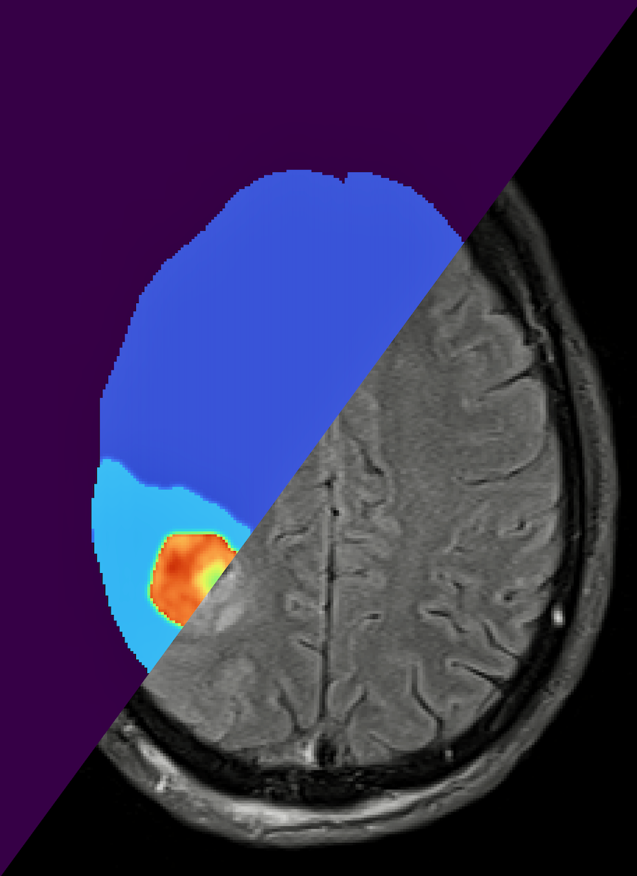 With Digital Twins of Brain Tumors, Computational Scientists are Personalizing Cancer Care