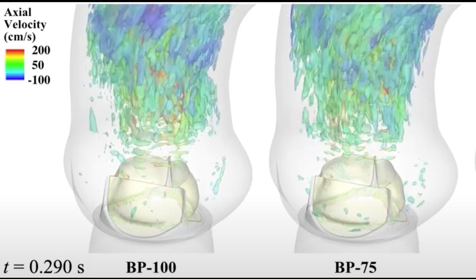 Computational Modeling Techniques Enable Unprecedented Visualizations of Heart Valve Implant Behavior